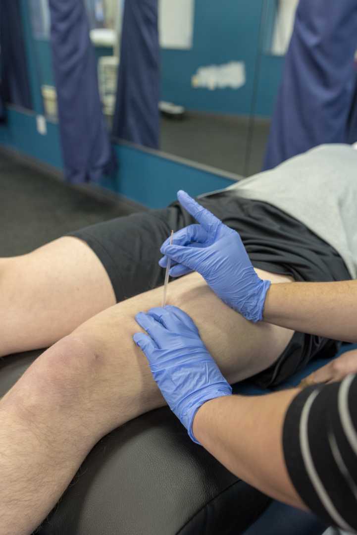 acupuncturemuscleslegneedlestcmraccoastalsportsandwellness