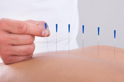 Sport Acupuncture