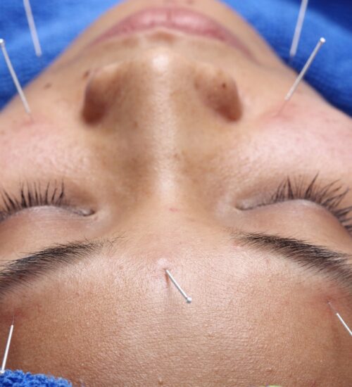 acupuncture fertility halifax