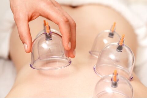 Cupping Therapy in Halifax - Coastal Sports and Wellness