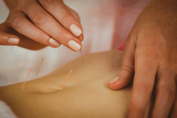 Finding Balance  – How Fertility Acupuncture Can Support Your Journey