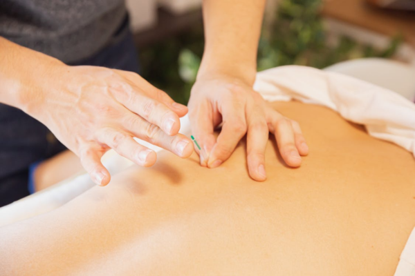 Dry Needling vs Acupuncture: Key Difference