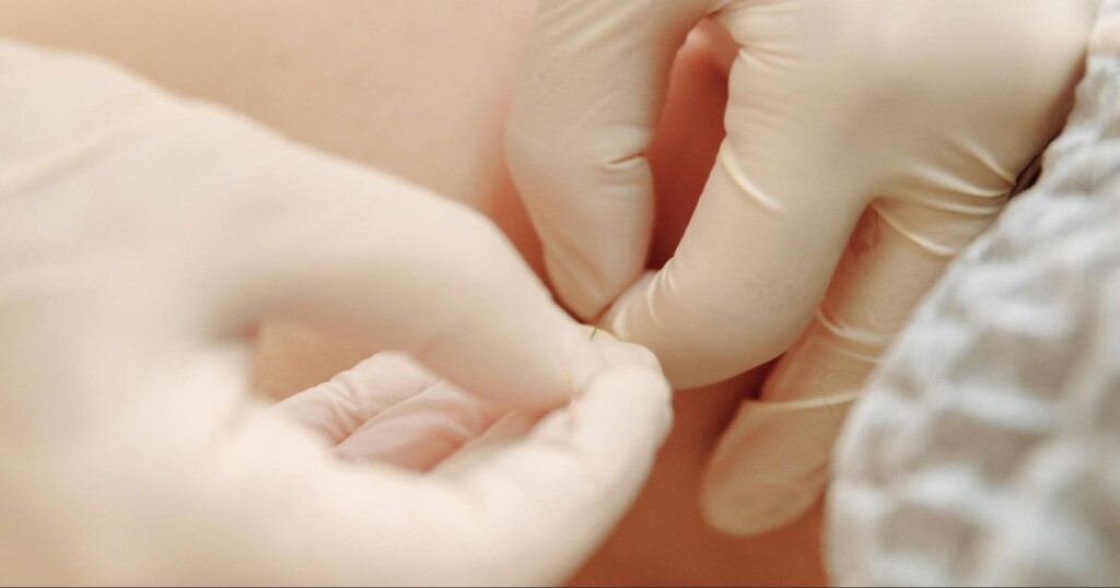 MAY 13, 2026 Best Dry Needling in Halifax: Pricing, Benefits & Sessions Explained