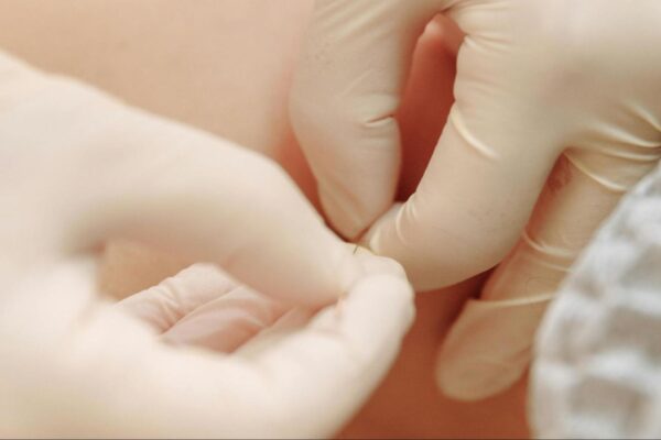 Best Dry Needling in Halifax: Pricing, Benefits & Sessions Explained